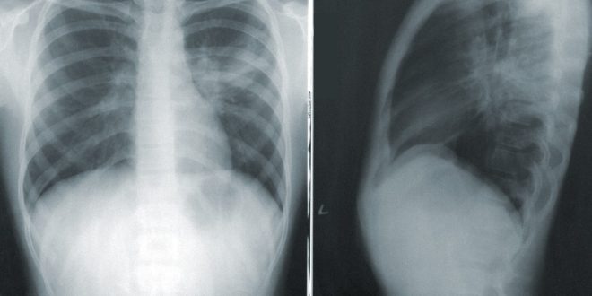 spine ribs xray scaled