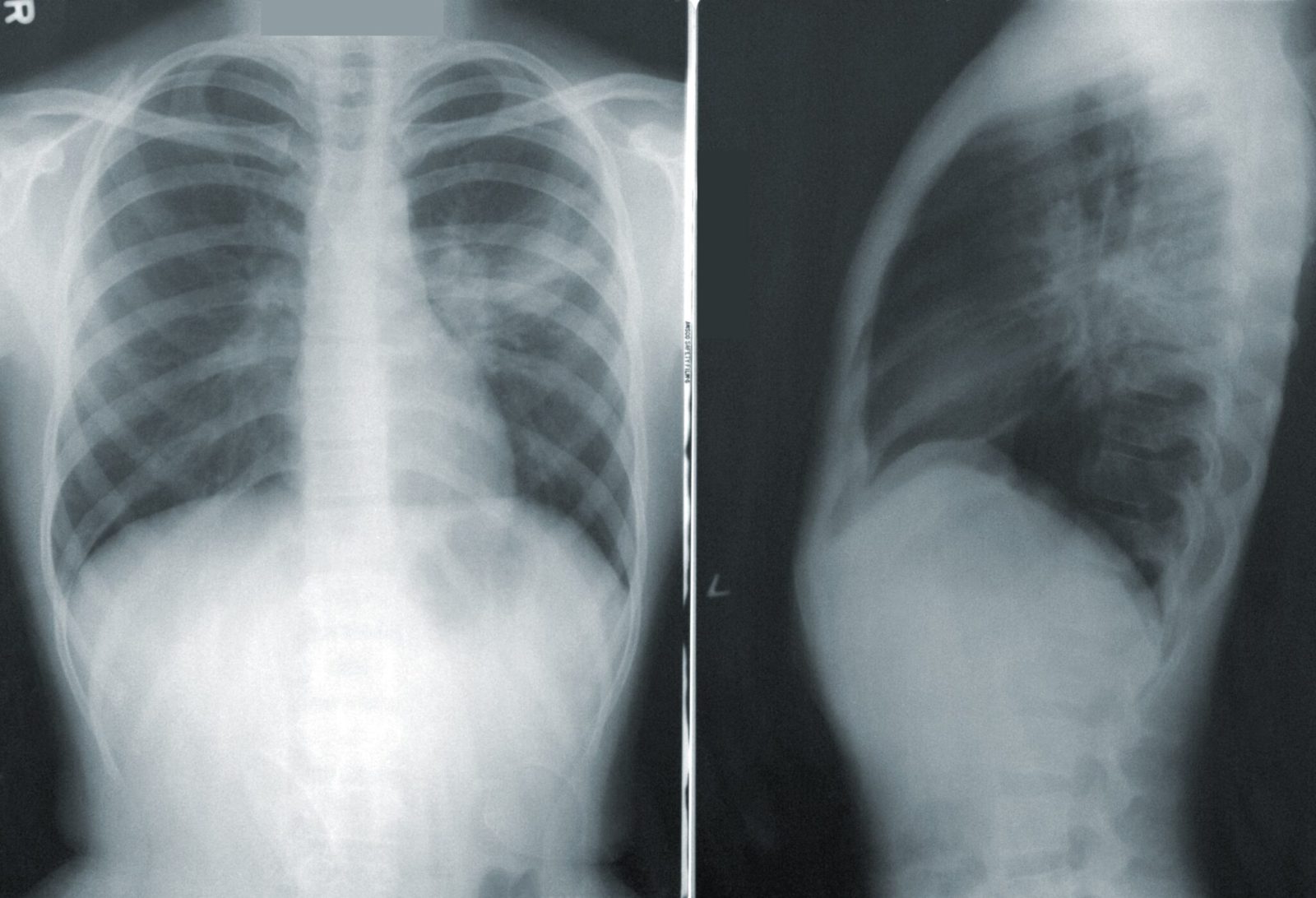 spine ribs xray scaled